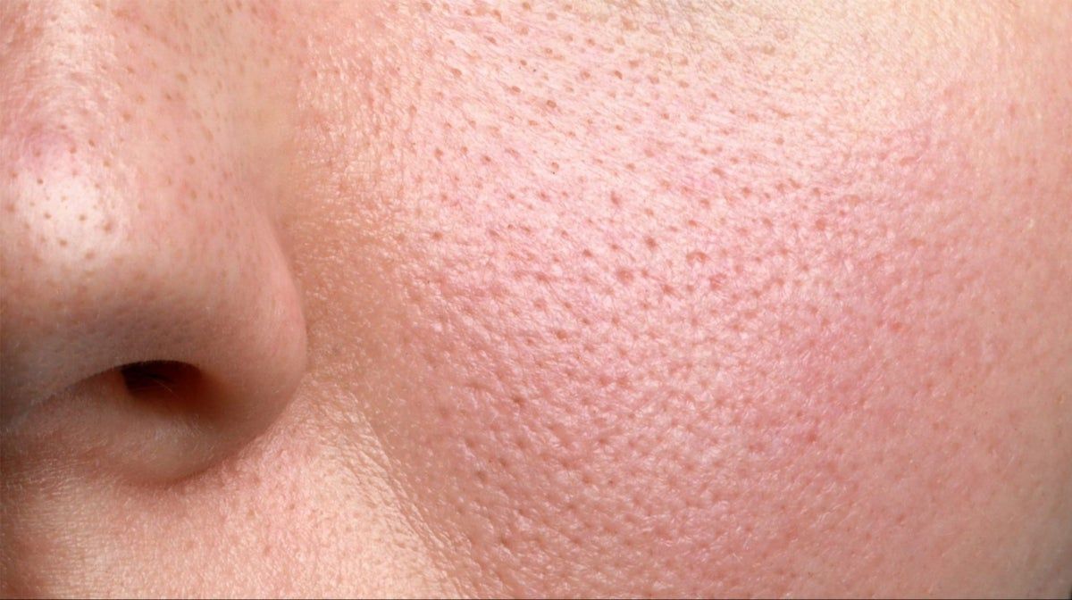 5 cách chăm sóc da nhờn, lỗ chân lông to